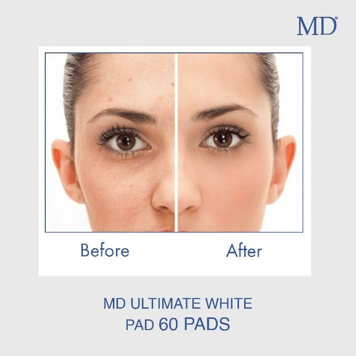 Before and after using MD Ultimate White Pad showing a clearer, brighter, and more even-looking skin tone